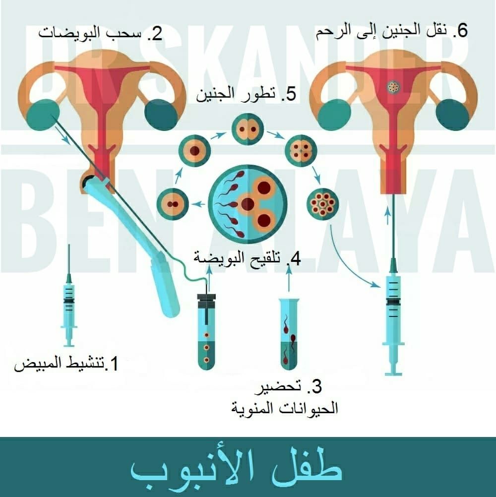 مراحل، تكلفة ونسبة نجاح عملية طفل الأنابيب