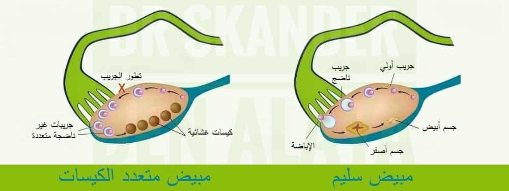 لا يوجد علاج لمرض تكيس المبايض لكن التشخيص المبكر لمتلازمة تكيس المبايض يُساعد على تجنب تطور الأعراض والتحكم فيها