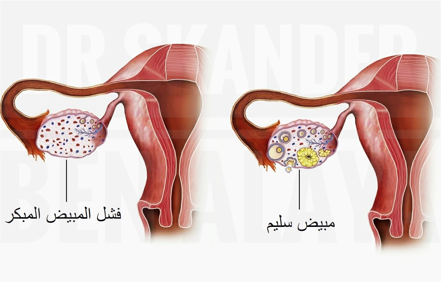 يعني مرض فشل المبيض المبكر إنخفاض كفاءة المبيضين وعجزهما على إنتاج منتظم للبويضات.