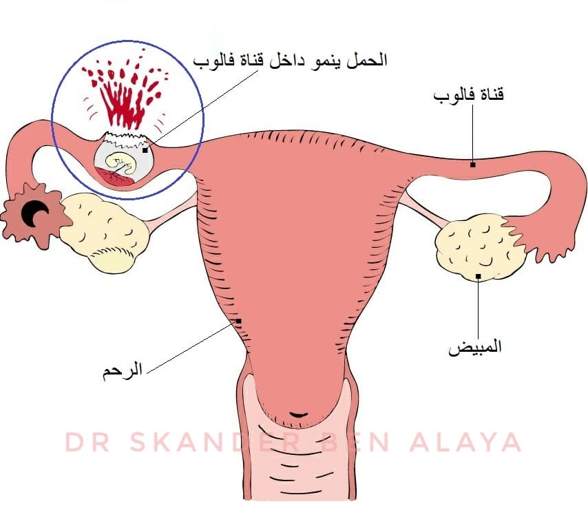 الحمل خارج الرحم – الحمل المنتبذ