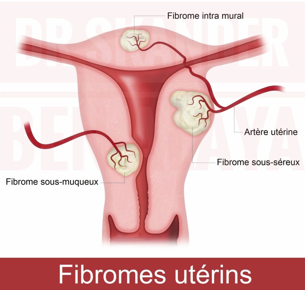 Fibrome utérin et désir de grossesse