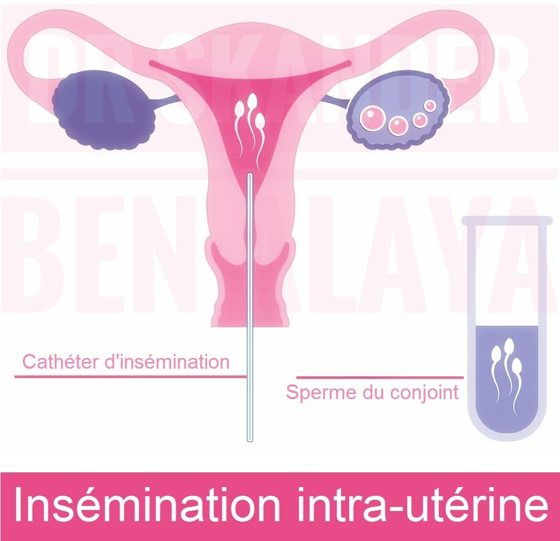 Insémination artificielle intra-utérine avec sperme du conjoint (IAC)