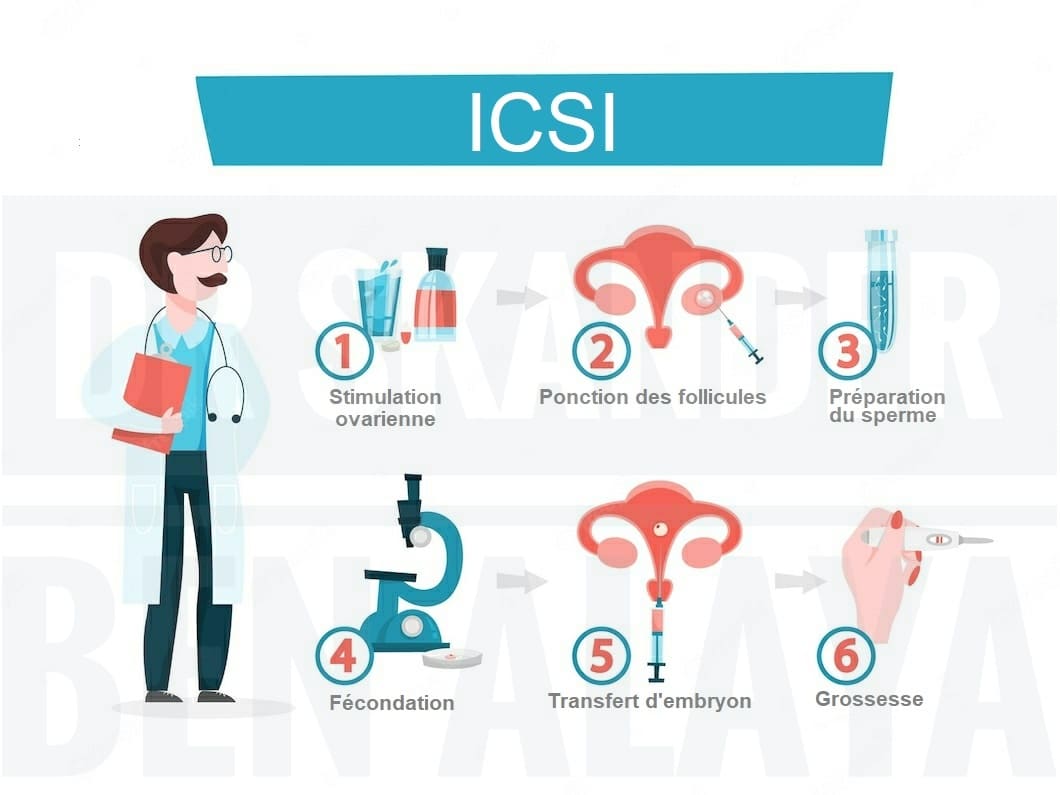 Les étapes de la fécondation in vitro par micro-injection (ou ICSI)