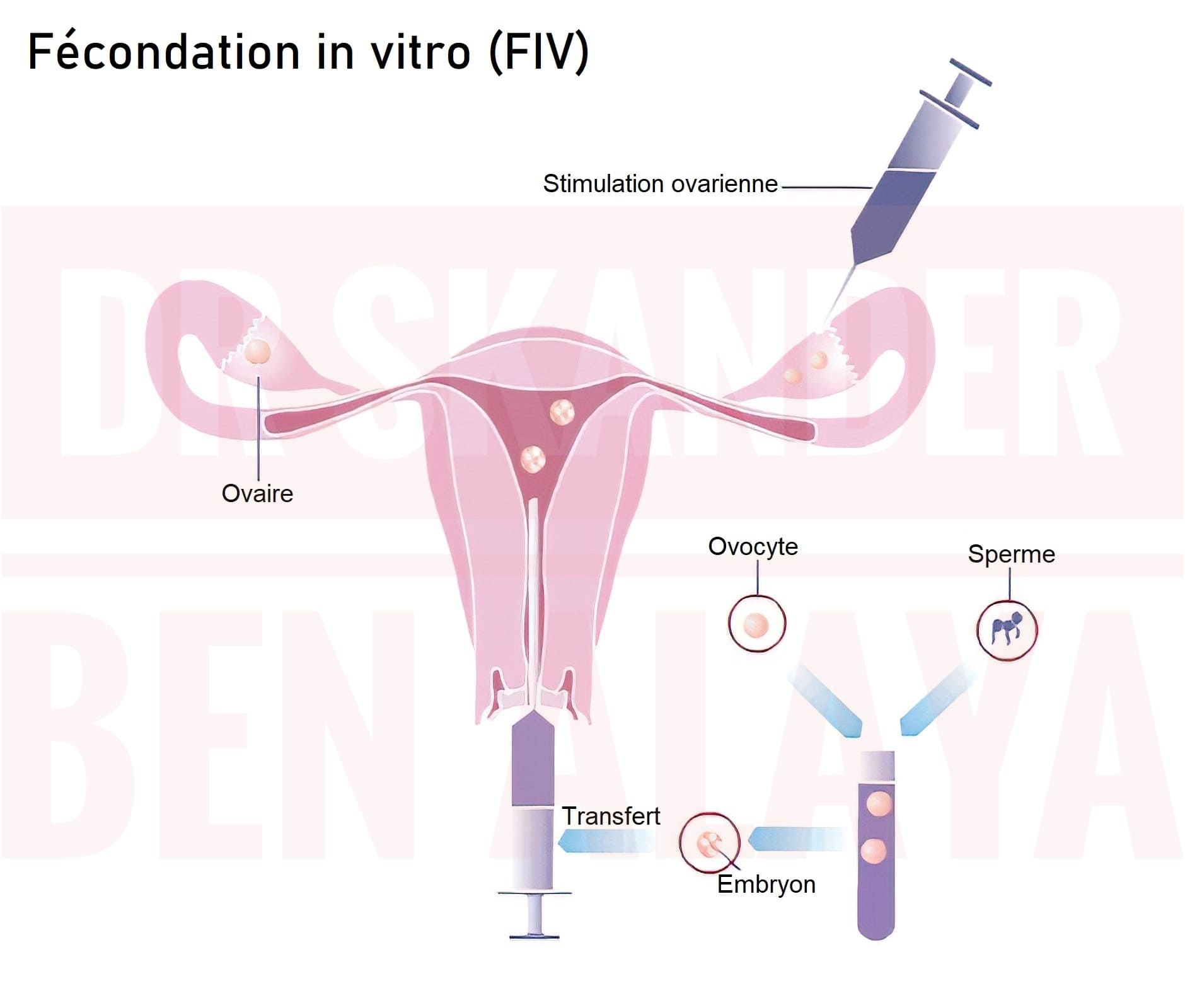 La fécondation in vitro, encore appelée FIV, est une technique de PMA.