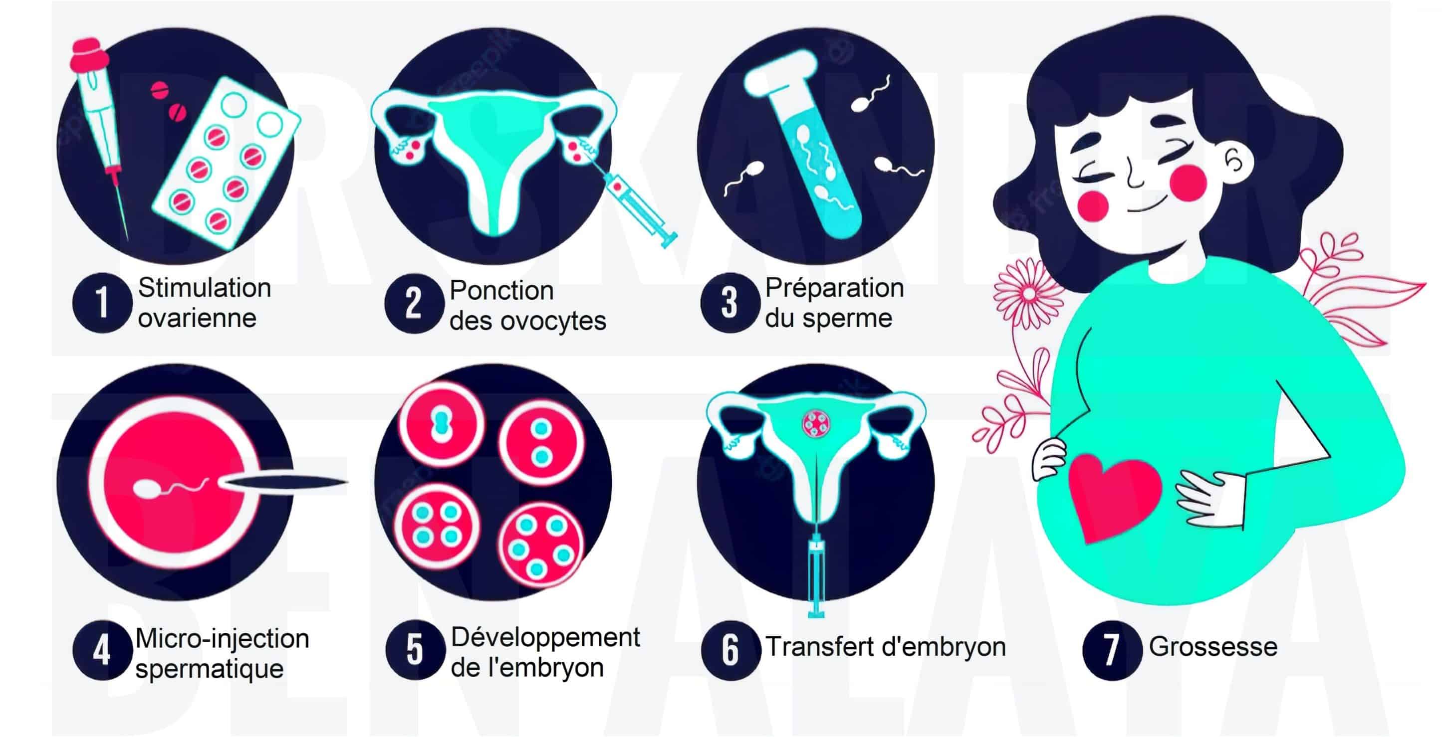 Le processus de l'injection intracytoplasmique de spermatozoïde (ICSI)