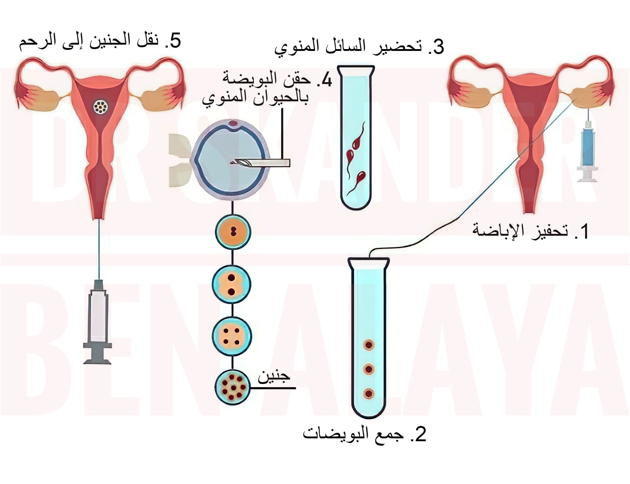 4. تكاليف عملية الحقن المجهري لتحديد جنس الجنين