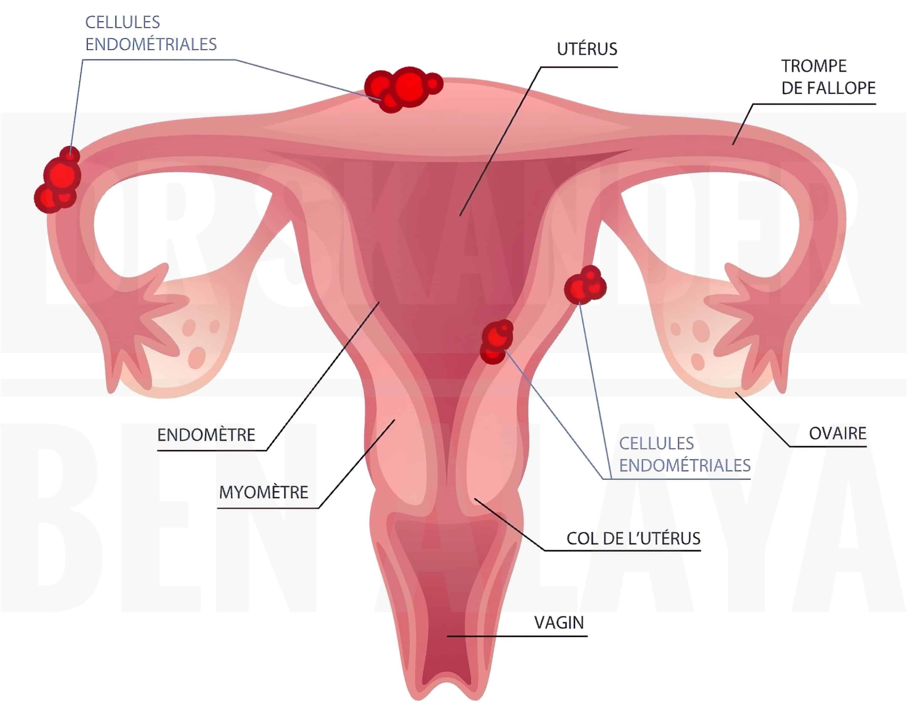 Endométriose: Définition, symptômes, diagnostic, traitements et risques d'infertilité.