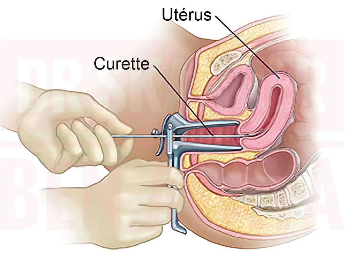 Curetage de la cavité utérine