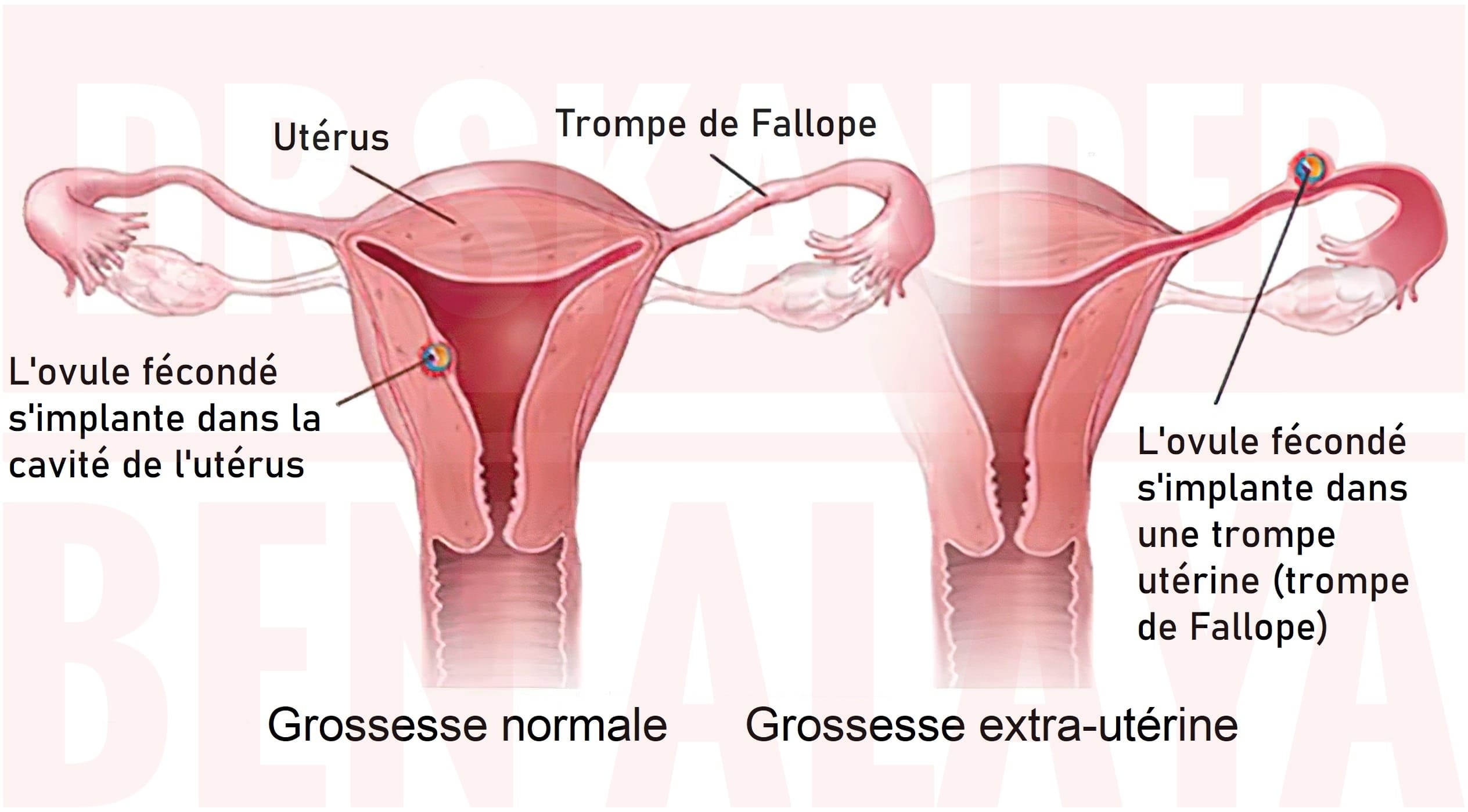 La plupart du temps, la grossesse extra-utérine se développe dans la trompe de Fallope.