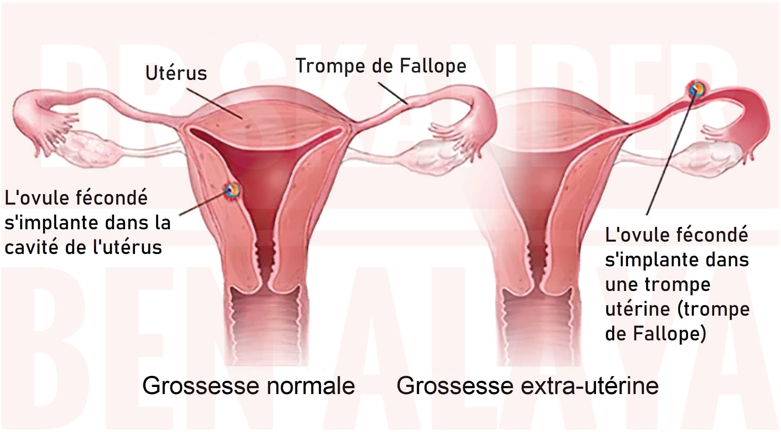 La plupart du temps, la grossesse extra-utérine se développe dans la trompe de Fallope.