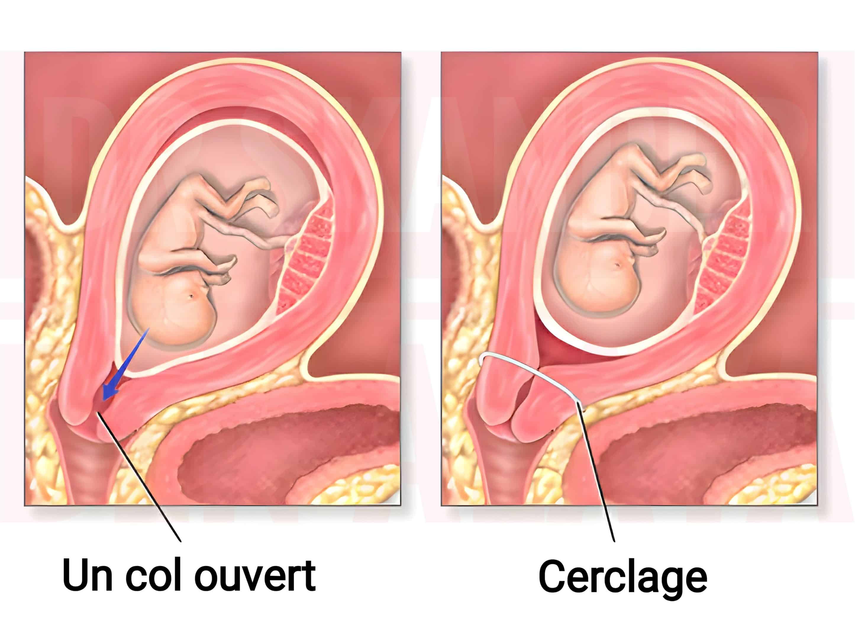 Le cerclage du col de l'utérus, chez une femme enceinte, est une procédure chirurgicale qui a pour objet de soutenir le col utérin pendant la grossesse.