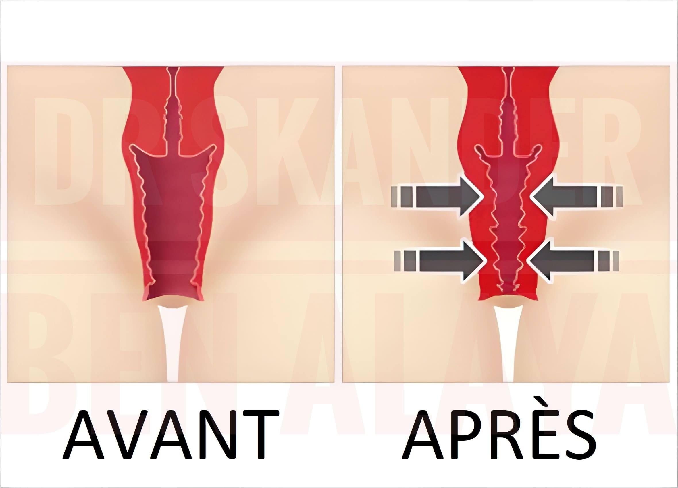 La vaginoplastie est une intervention chirurgicale visant à resserrer le plancher musculaire vaginal.