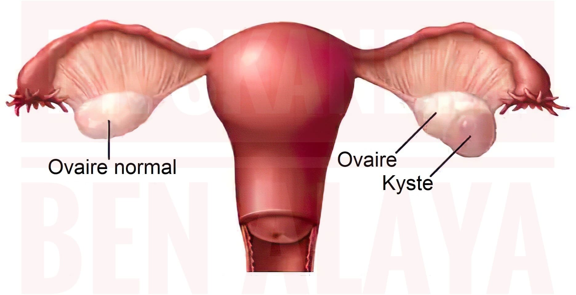 Le kyste de l'ovaire est une tumeur bénigne qui se développe au niveau des ovaires.
