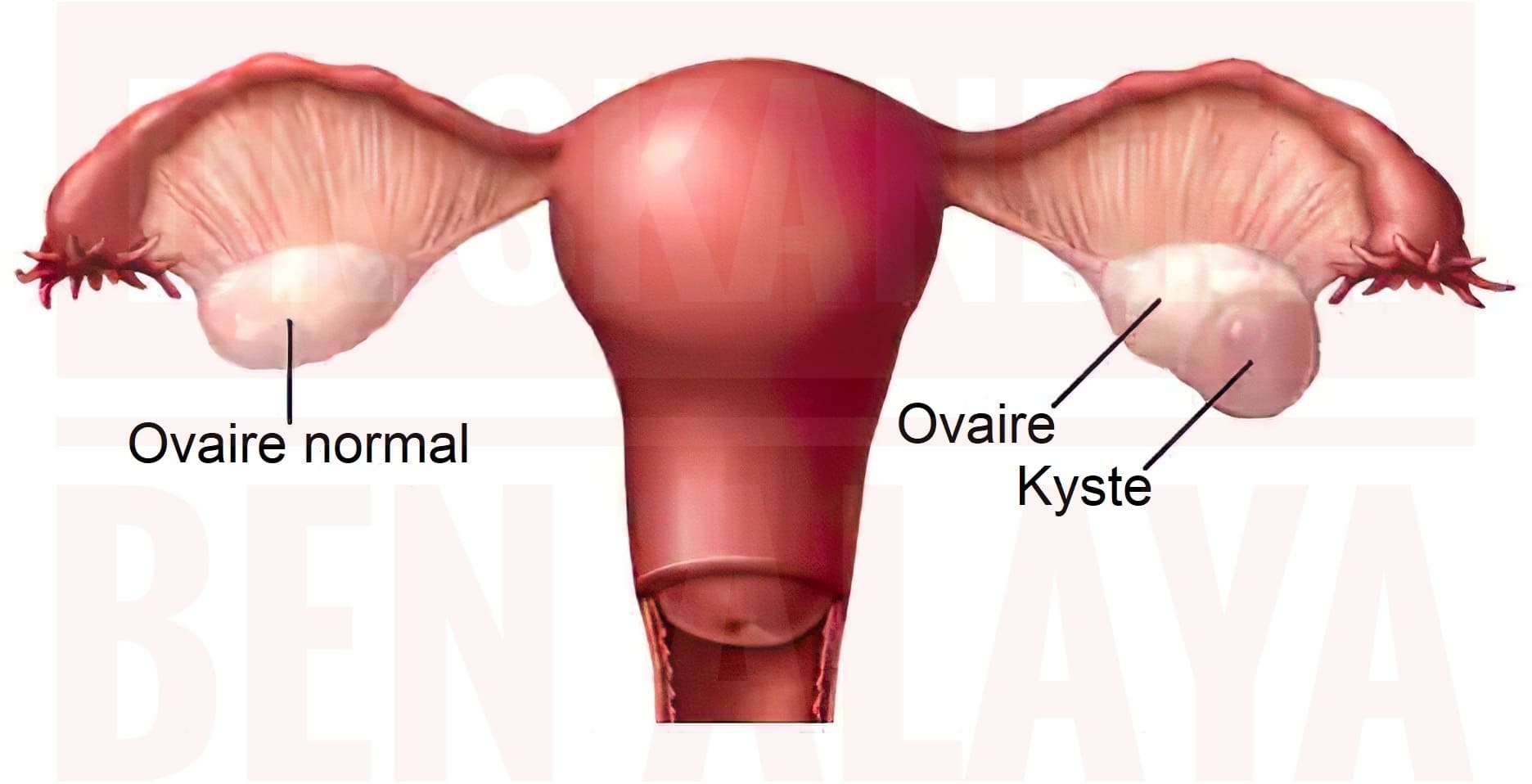 Kyste de l'ovaire (ou kyste ovarien)