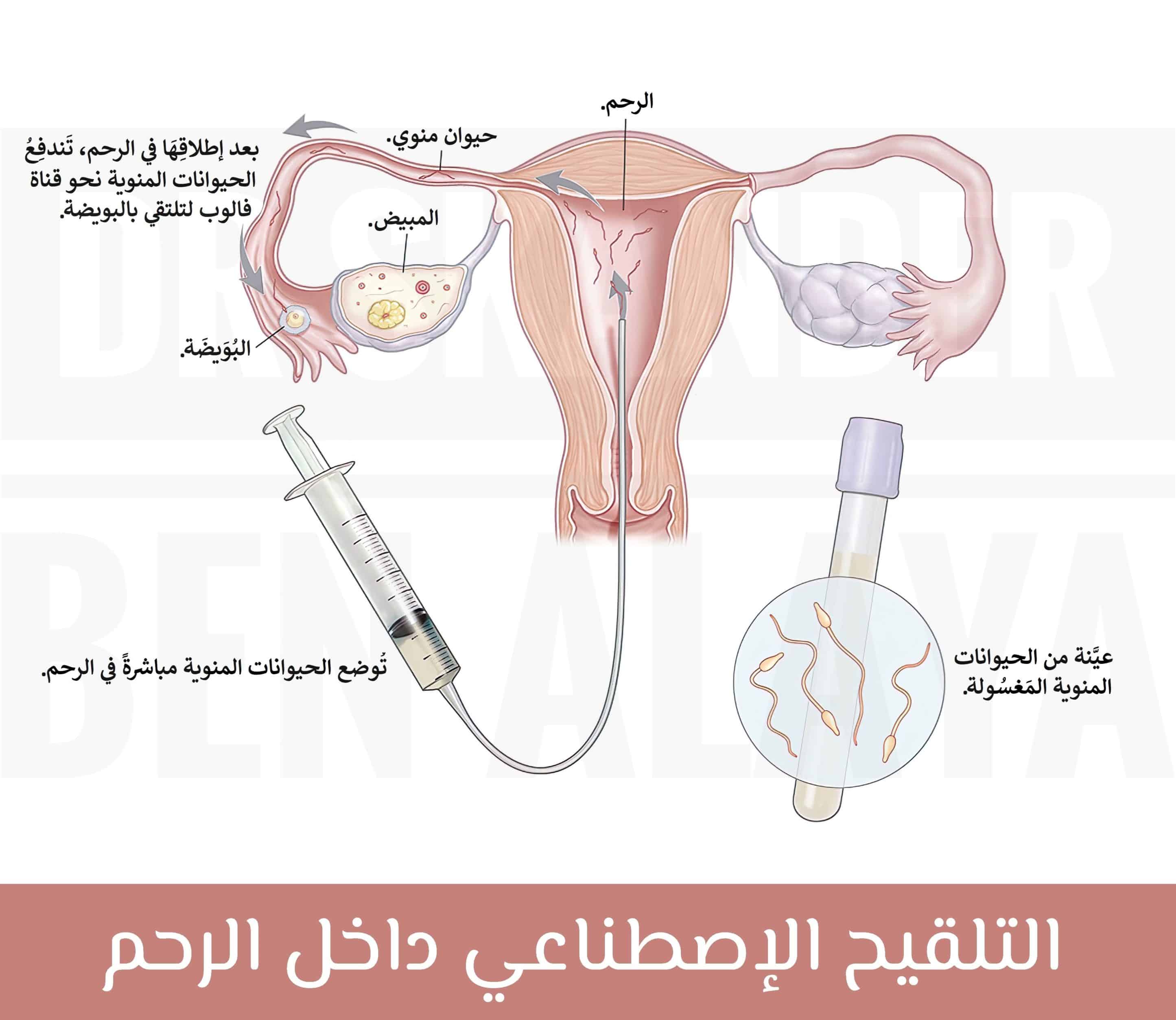 يعتمد التلقيح الإصطناعي داخل الرحم على تلقيح البويضة بوضع الحيوانات المنوية مباشرة في رحم المرأة