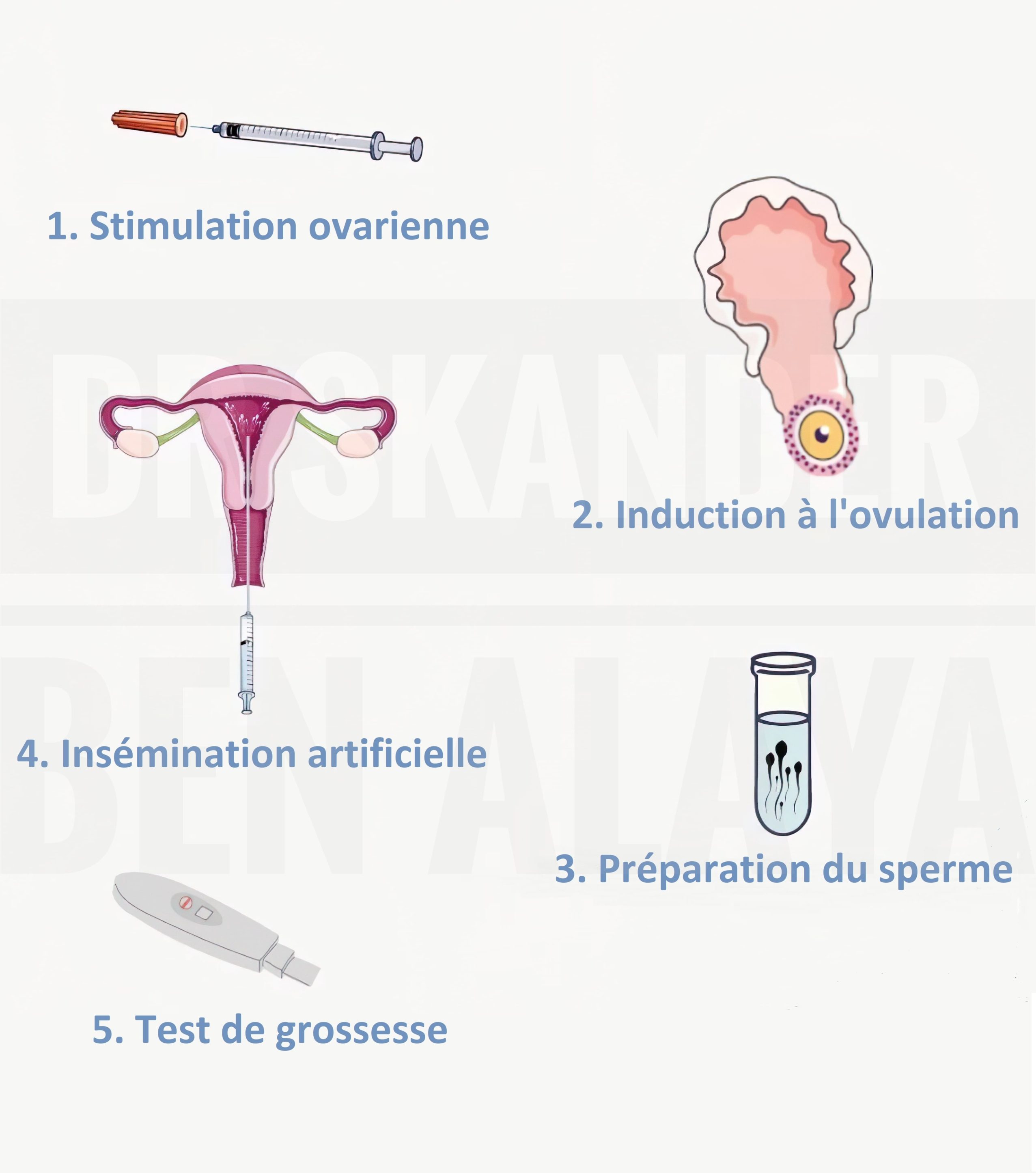 Insémination artificielle intra-utérine avec sperme du conjoint (IAC).