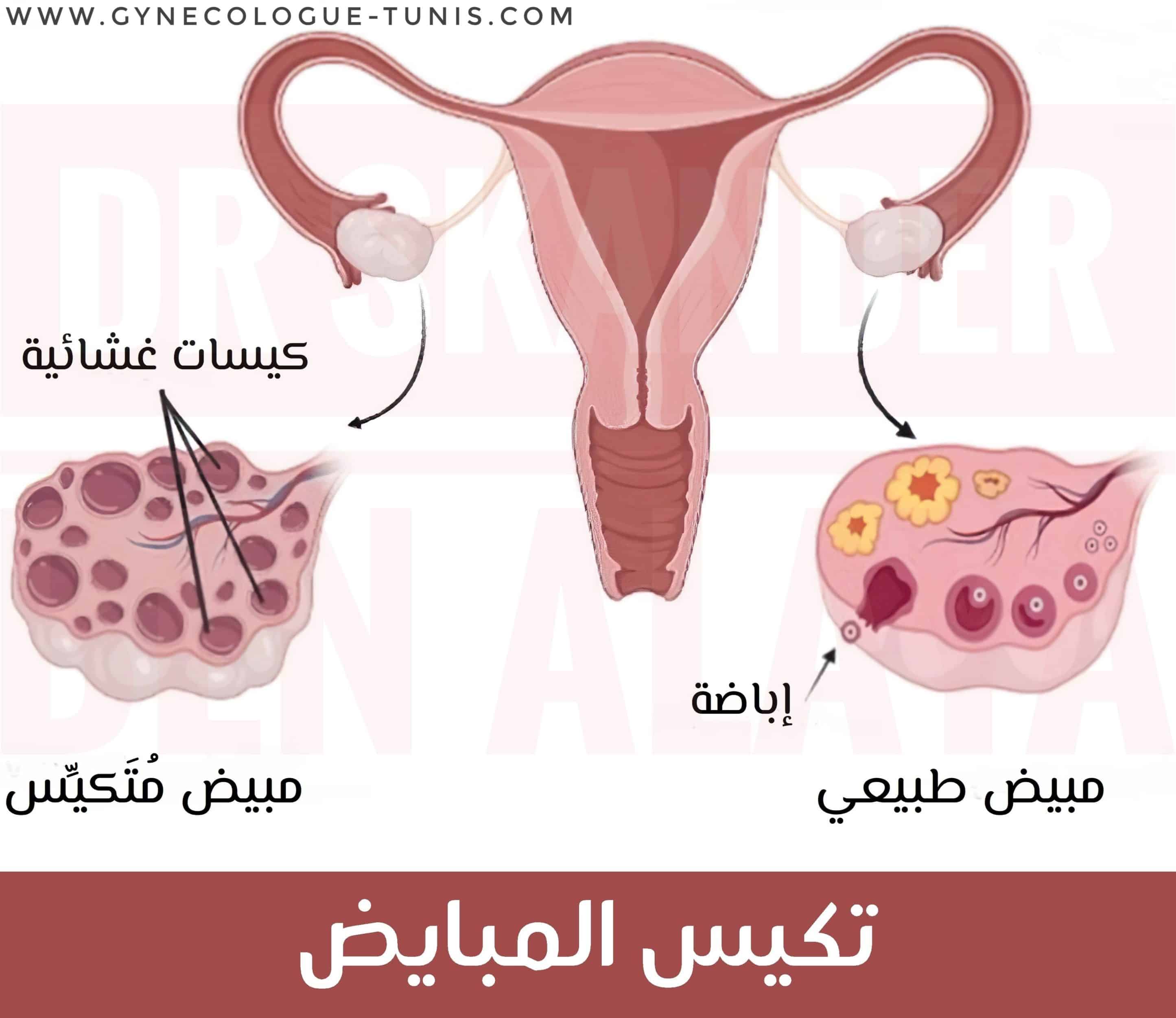 تكيس المبايض - متلازمة المبيض متعدد التكيسات