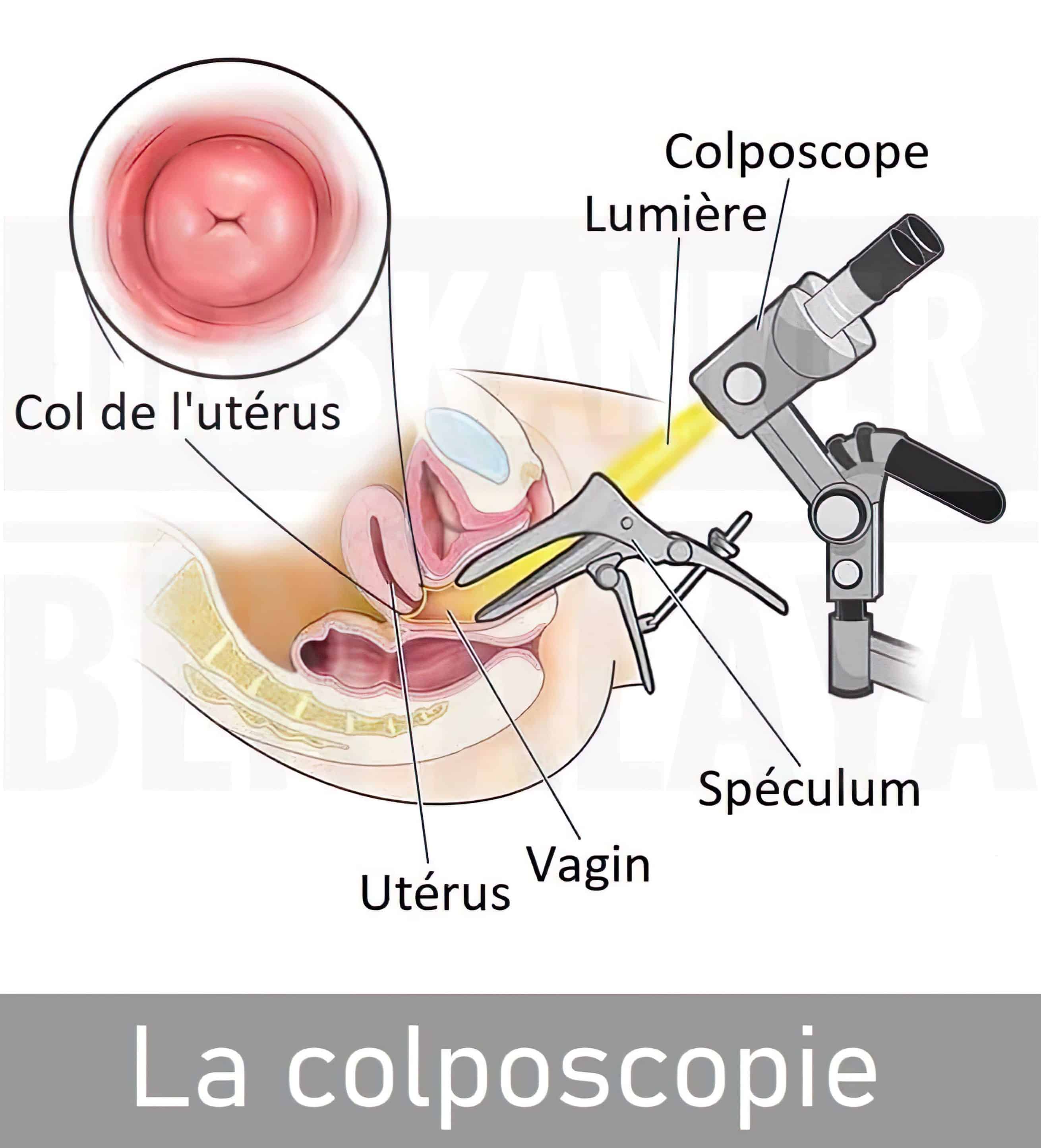 Colposcopie