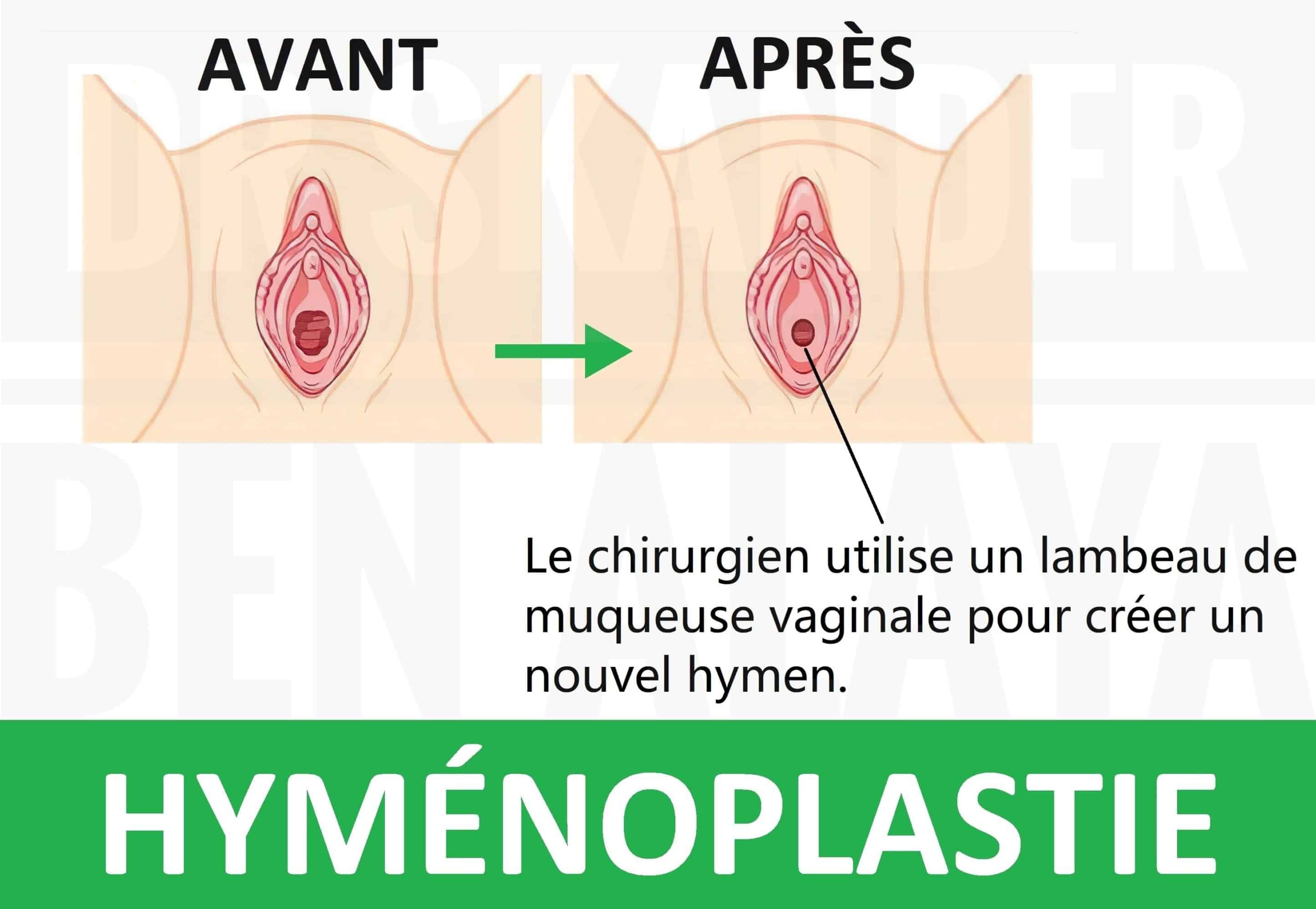 Une hyménoplastie est une opération qui vise la reconstruction définitive de l'hymen déchiré.