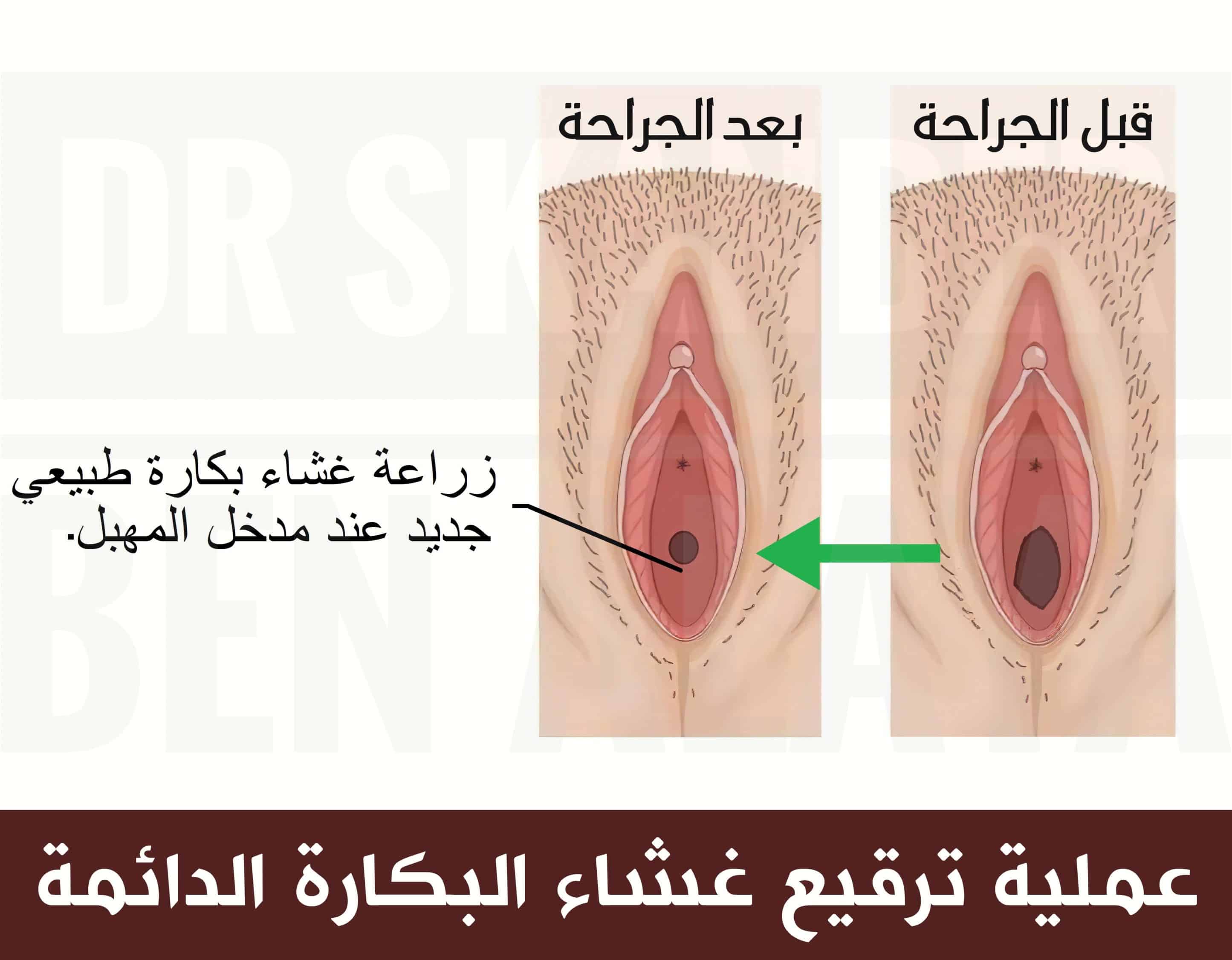 في حال عدم وجود بقايا كافية من النسيج الغشائي، يُوصي الطبيب بإجراء عملية ترقيع غشاء البكارة الدائمة. يُوفِّر الترقيع الدائم للغشاء راحة نفسية لضحايا الإغتصاب.