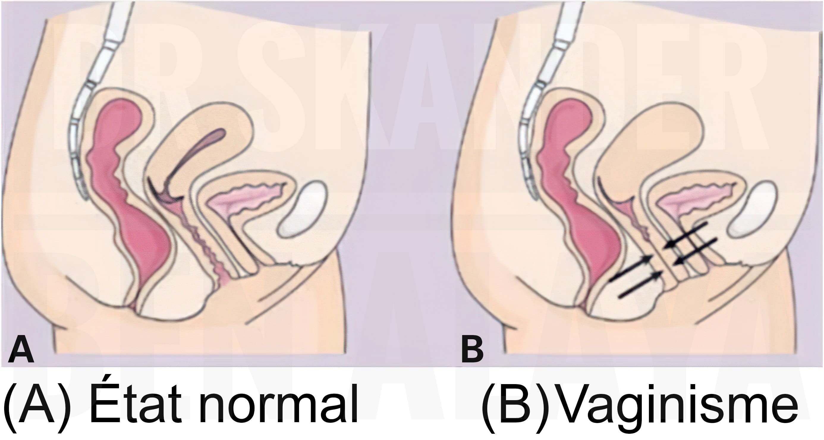 Le vaginisme se caractérise par la contraction involontaire des muscles constricteurs du vagin.