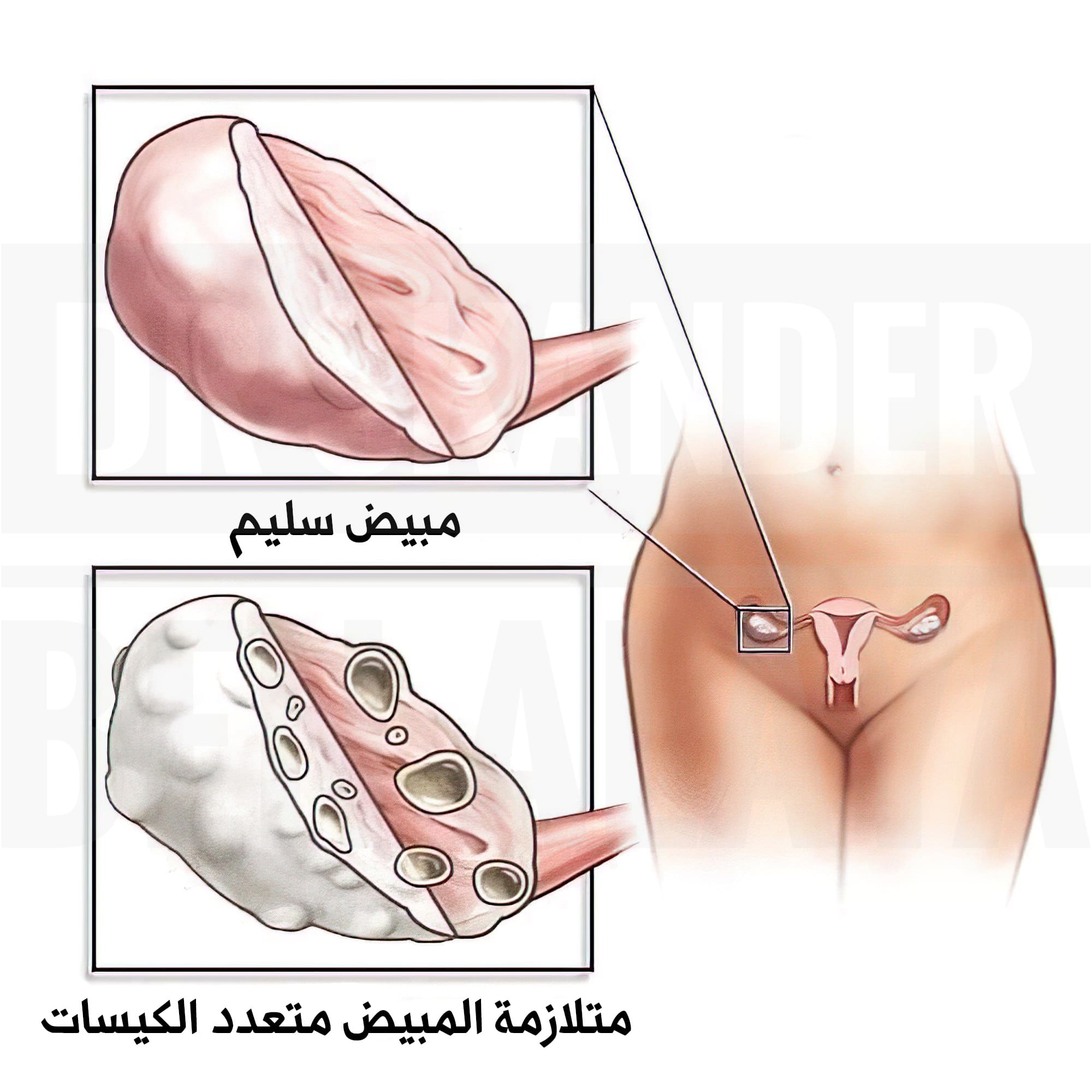 تأثير الإصابة بمتلازمة المبيض متعدد الكيسات على الحمل.