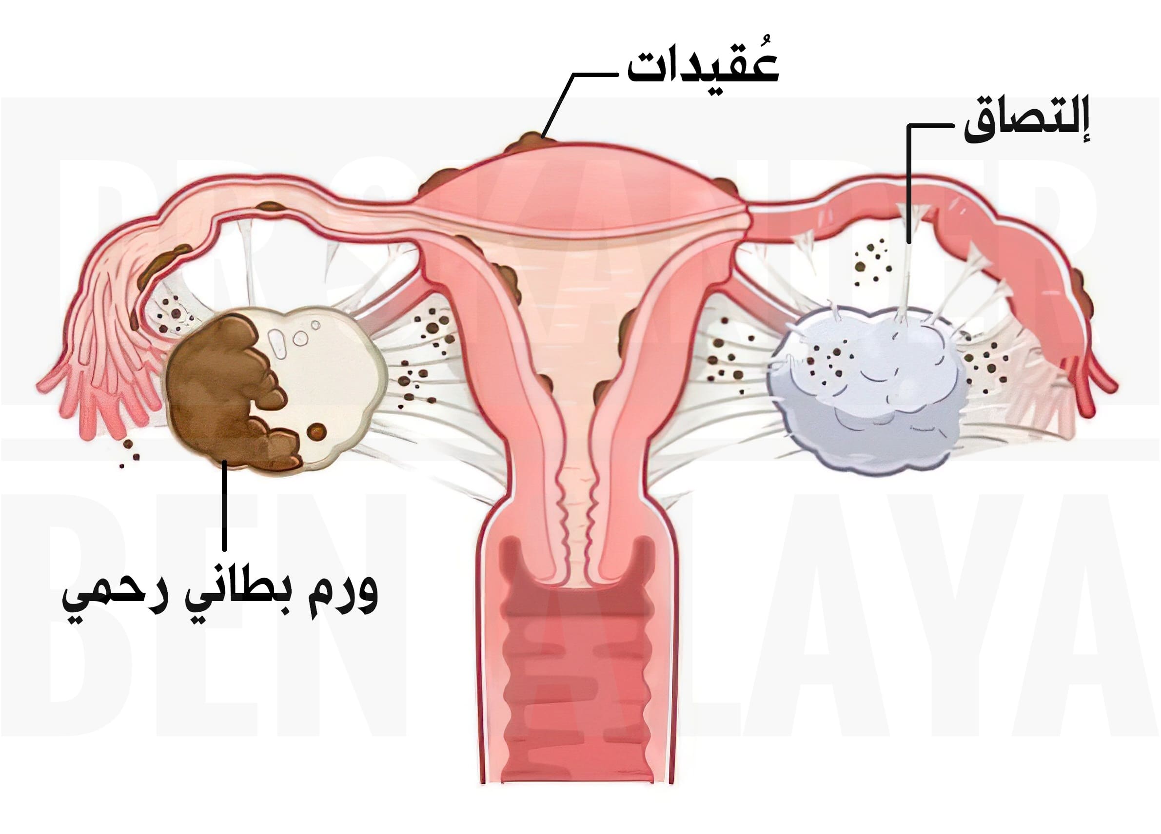 بطانة الرحم المهاجرة - الأعراض، الأسباب، التشخيص والعلاج