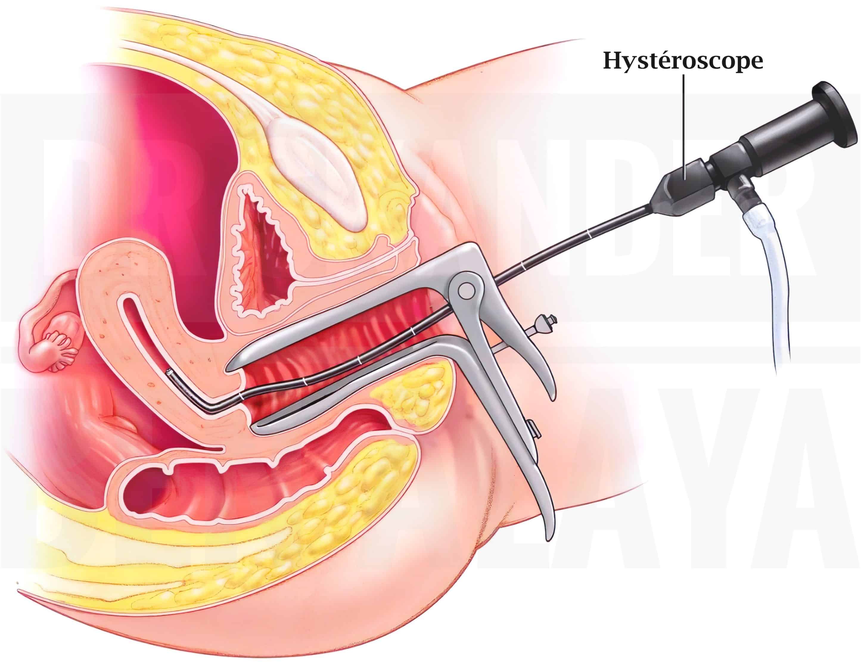 Hystéroscopie diagnostique ou opératoire.