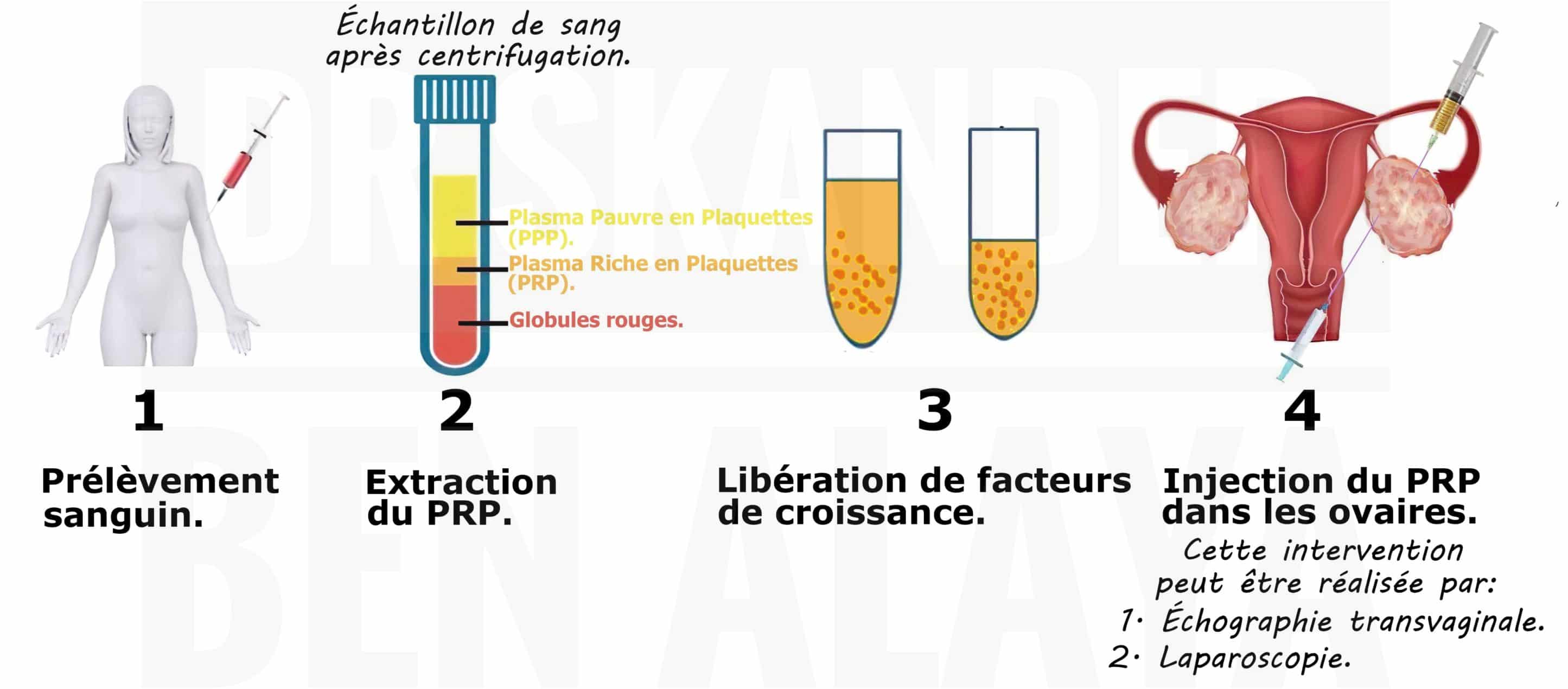 PRP ovarien : Le traitement par injection de plasma riche en plaquettes (PRP) dans les ovaires.