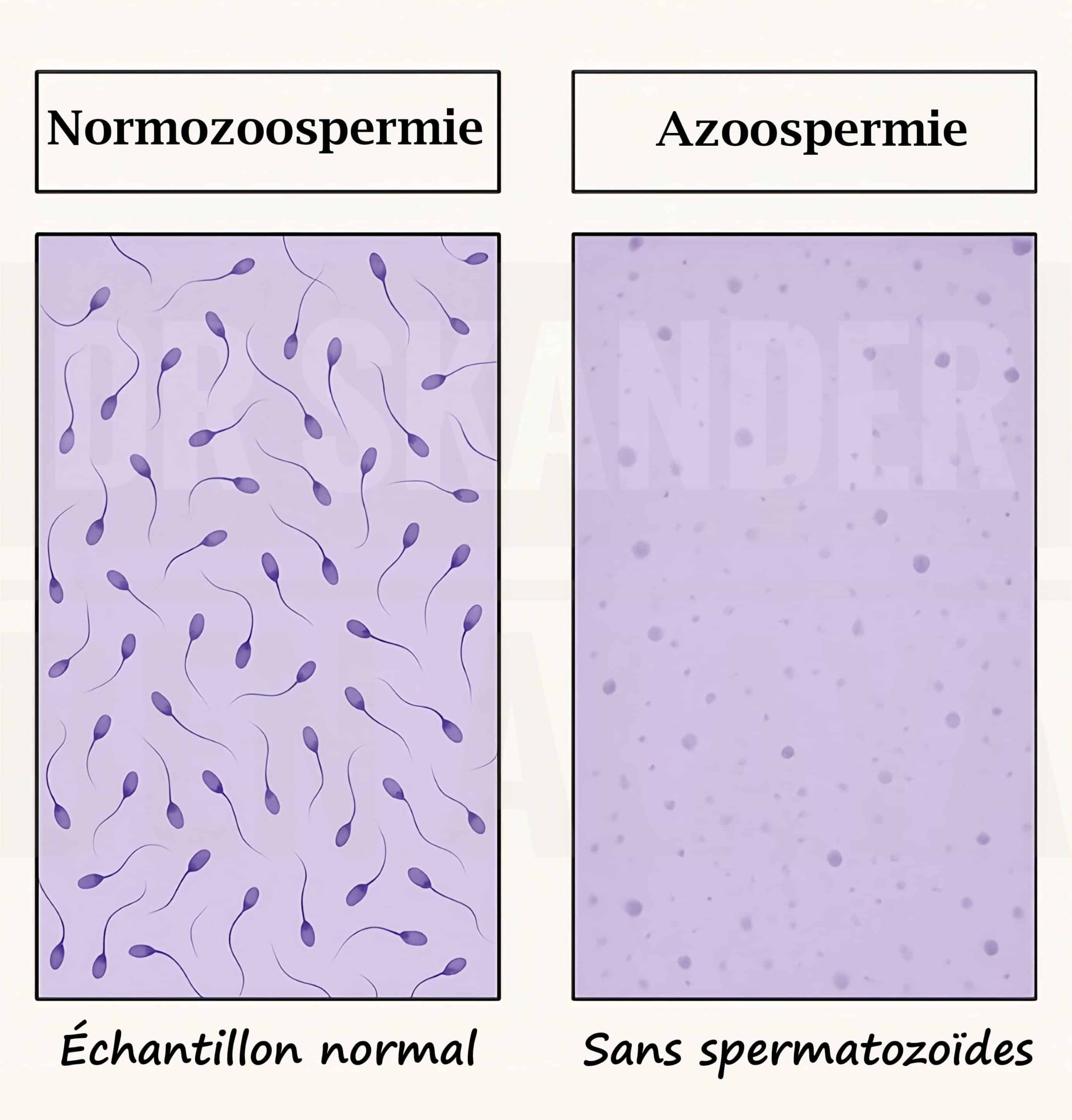 Azoospermie est un terme médical désignant l'absence totale de spermatozoïdes dans le sperme éjaculé.