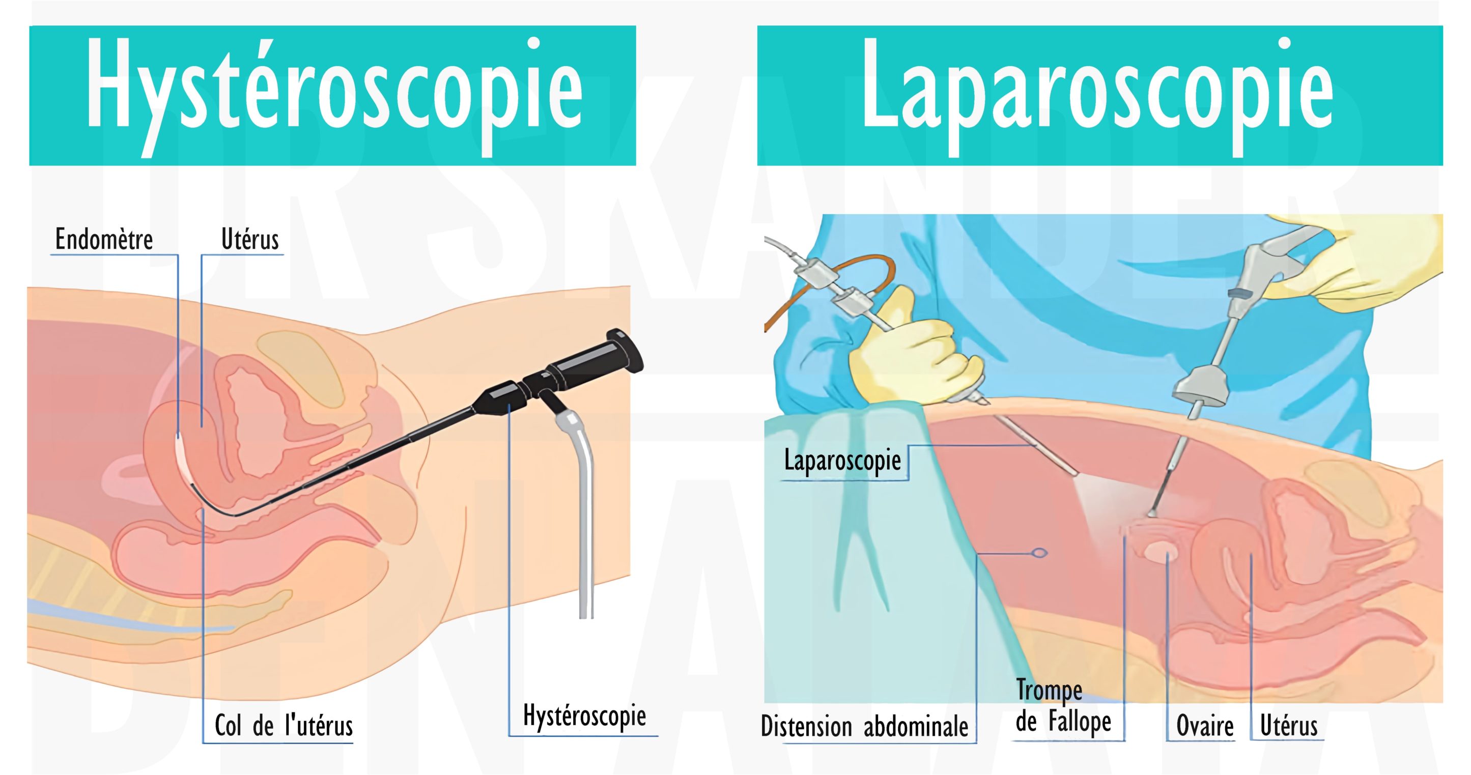 Chirurgie endoscopique gynécologique : hystéroscopie et laparoscopie Image illustrant deux techniques de chirurgie endoscopique gynécologique : l’hystéroscopie par voie utérine et la laparoscopie par voie abdominale.