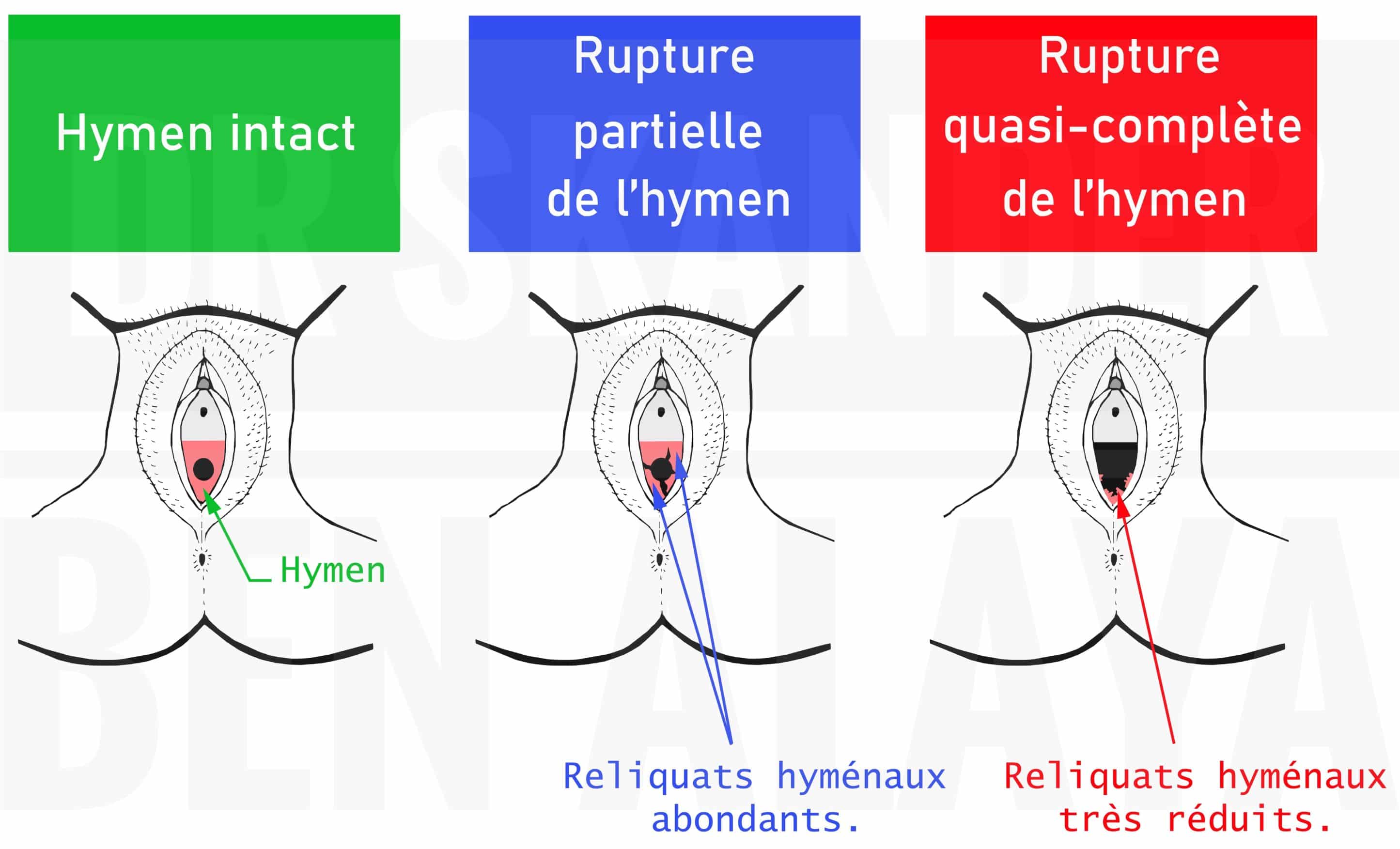 Hymen intact, rupture partielle et rupture quasi-complète.