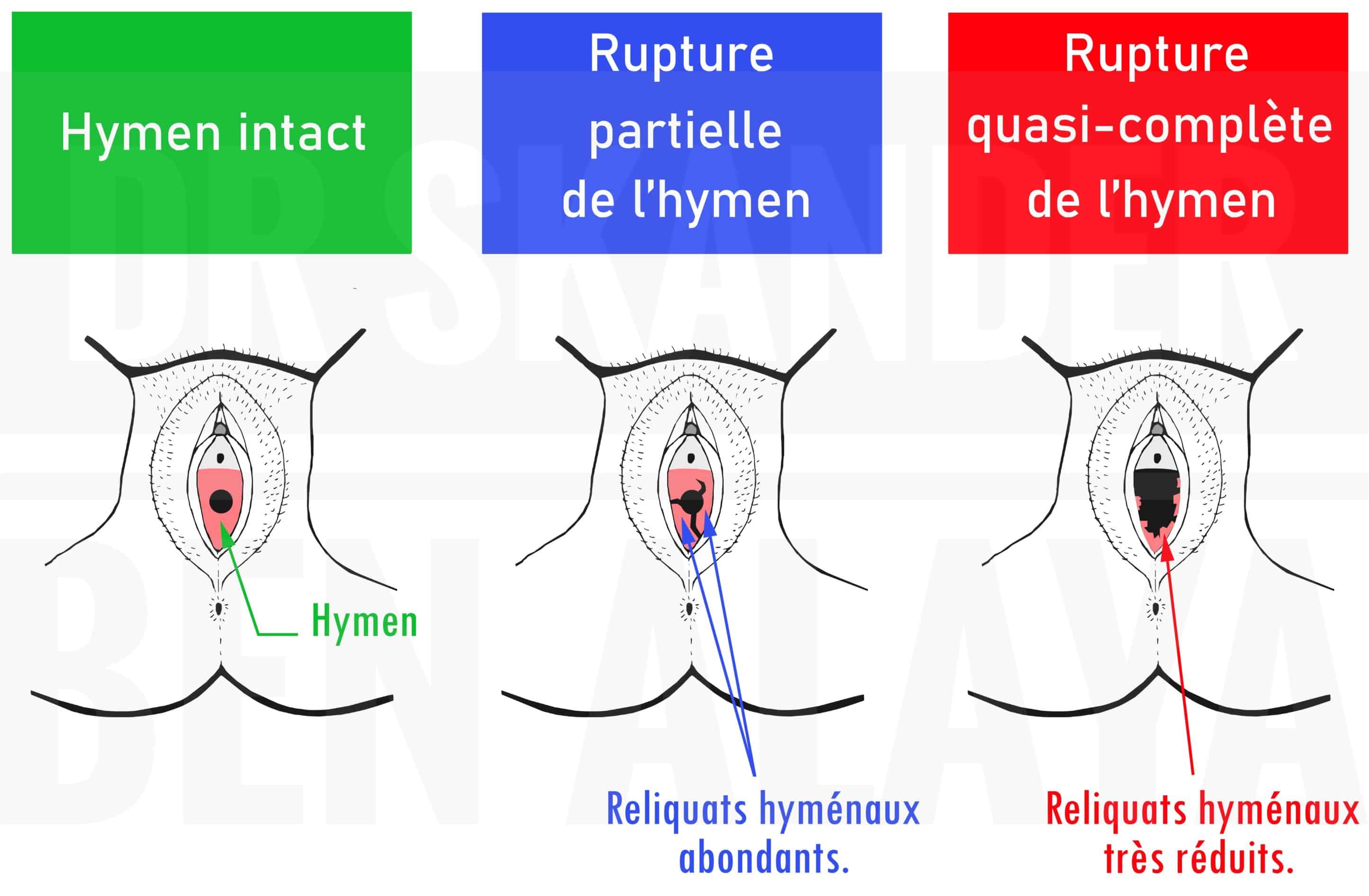 Hymen intact, rupture partielle et rupture quasi-complète.