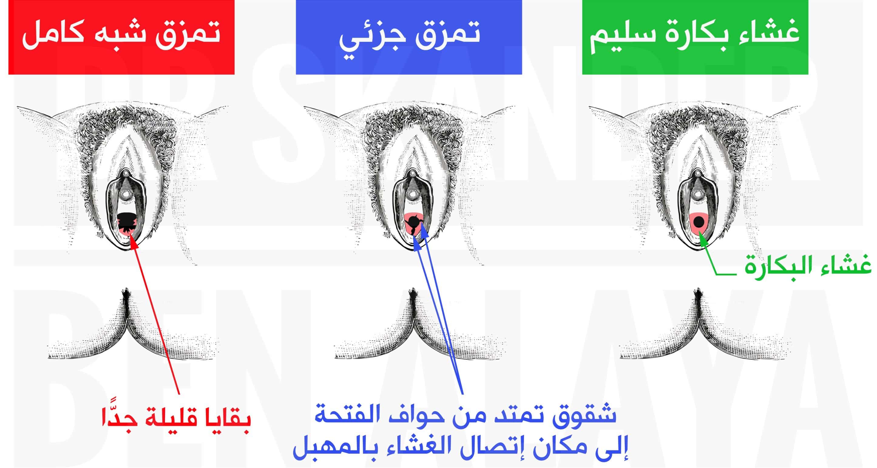 الفرق بين غشاء البكارة السليم والممزق.