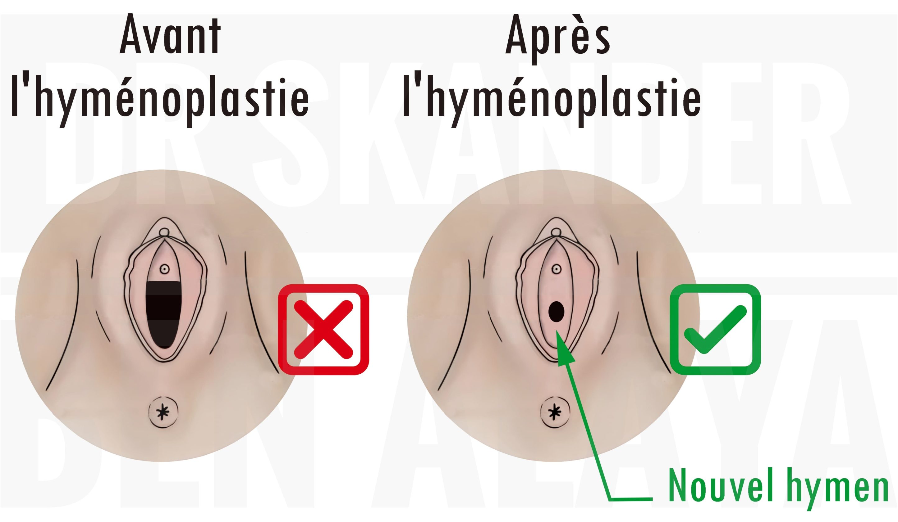 Hyménoplastie avant/après : nouvel hymen et préparation au mariage.