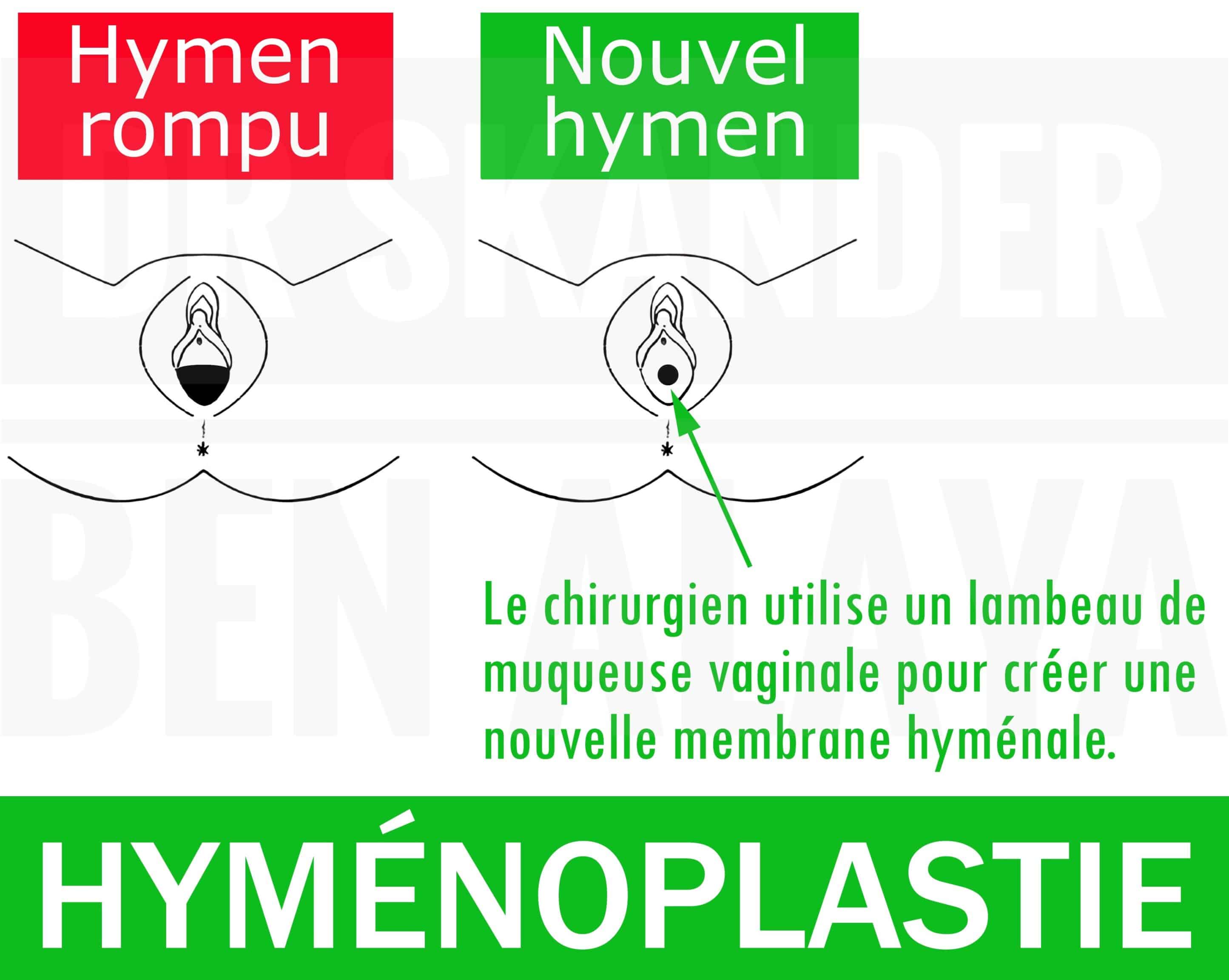 Hyménoplastie par lambeau vaginal.
