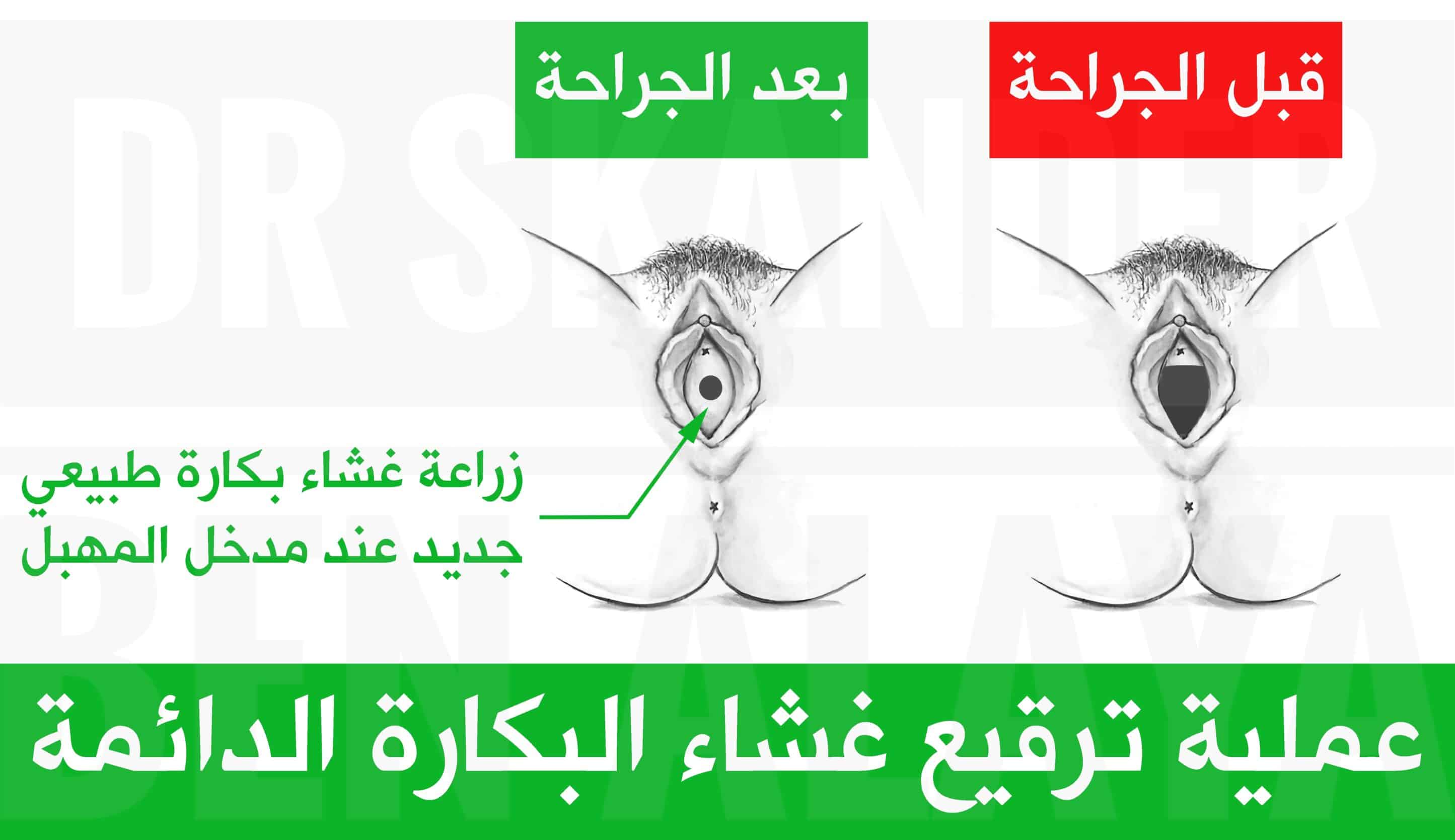 عملية ترقيع غشاء البكارة الدائمة بإستخدام سديلة مهبلية مأخوذة من الجدار الخلفي أو الجانبي للمهبل.