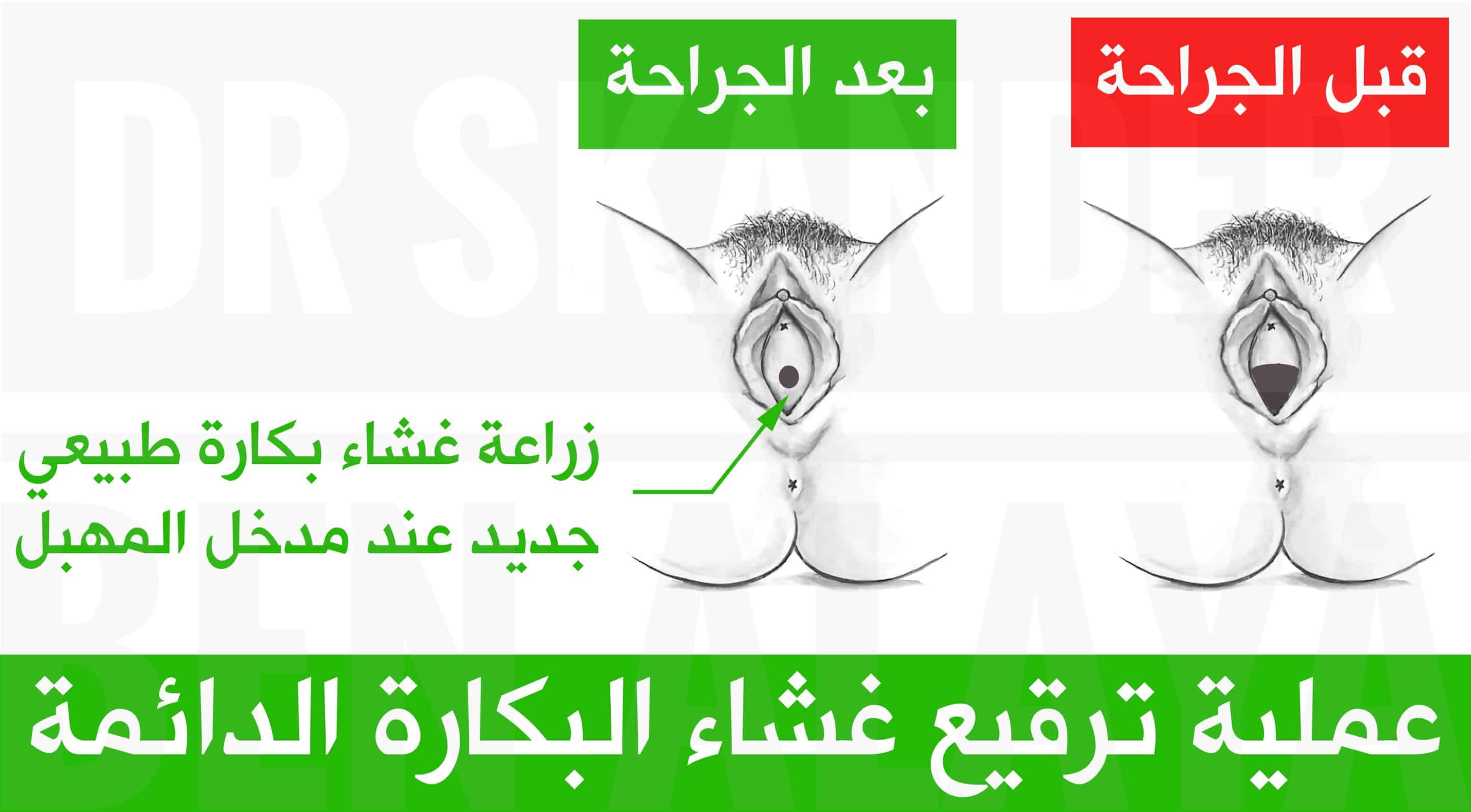 عملية ترقيع غشاء البكارة الدائمة بإستخدام سديلة مهبلية مأخوذة من الجدار الخلفي أو الجانبي للمهبل.