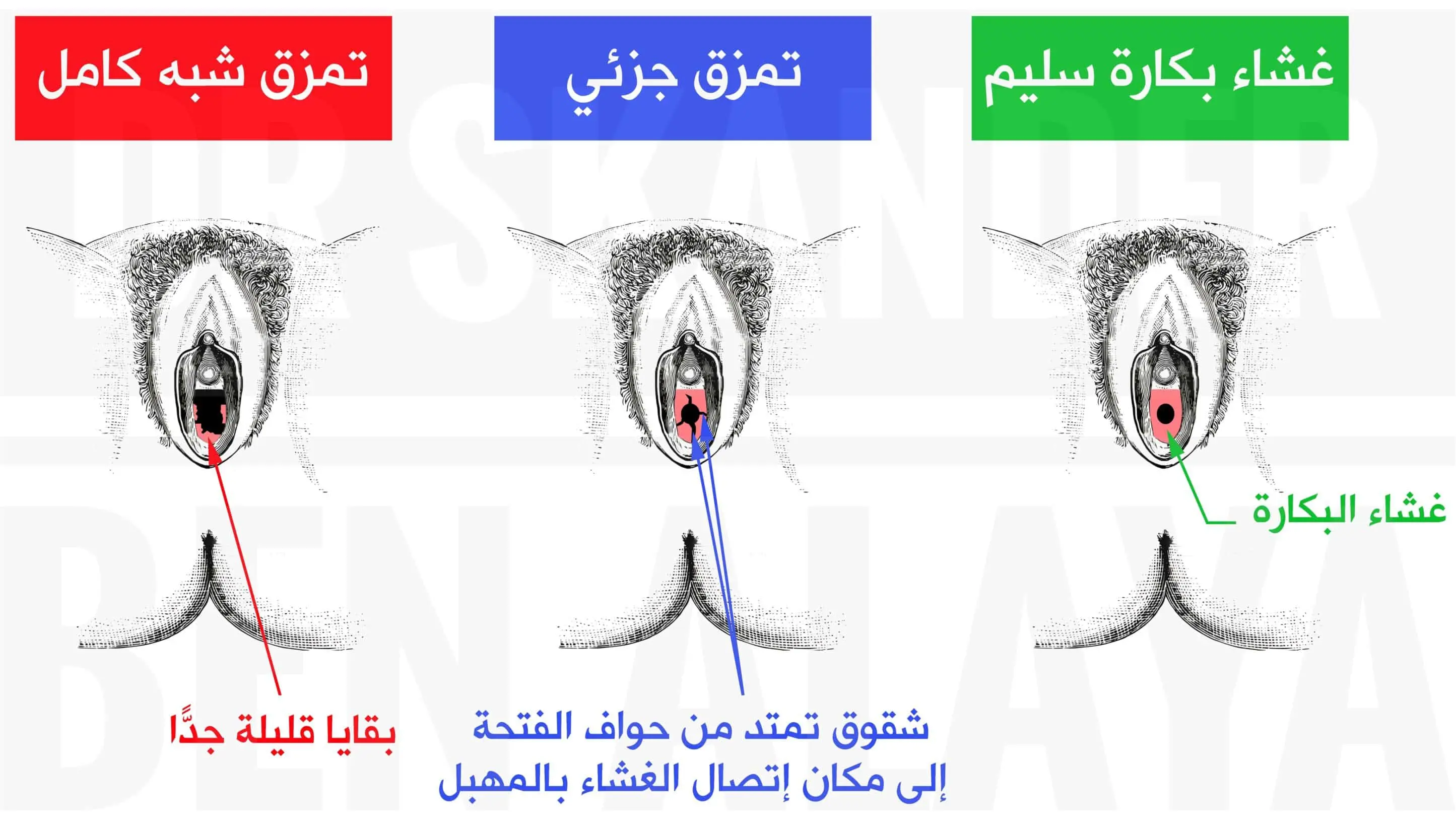 رسم تشريحي يوضّح الفرق بين غشاء بكارة سليم وتمزق جزئي وتمزق شبه كامل.